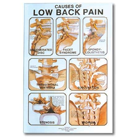 Causes Of Low Back Pain Poster 24" X 36" Laminate