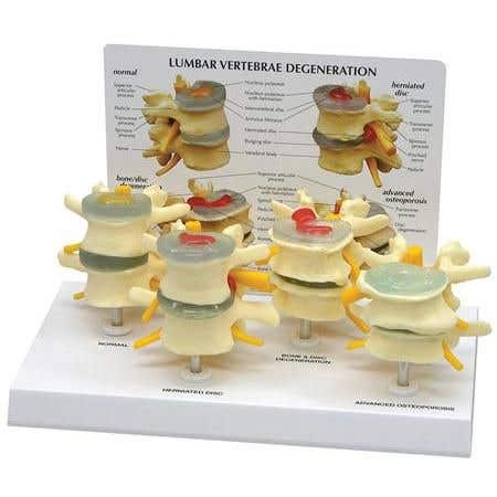 4 Stages Of Lumbar Degeneration - Model