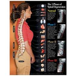 3 Phases Of Spinal Degeneration Chart 22X28 Lamntd