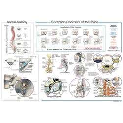 Common Disorders Of The Spine Poster 20" X 30"