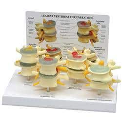 4 Stages Of Lumbar Degeneration - Model