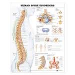 Human Spine Disorders 20" X 26" Laminate