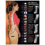 3 Phases Of Spinal Degeneration Chart 22X28 Lamntd