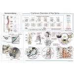 Common Disorders Of The Spine Poster 20" X 30"