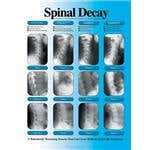 Spinal Decay Chart, Laminated