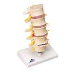 Stages Of Disc Prolapse & Vertebral Degeneration