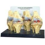Four Stage Osteoarthritis Knee Model