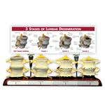 Magnetic Anatomical Lumbar Spine Degeneration Model