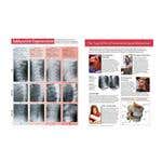 Subluxation Dengeration Handouts 50 Pack