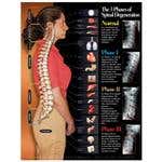 3 Phases Of Spinal Degeneration Chart 22X28 Lamntd