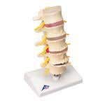 Stages Of Disc Prolapse &amp; Vertebral Degeneration