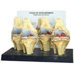Four Stage Osteoarthritis Knee Model