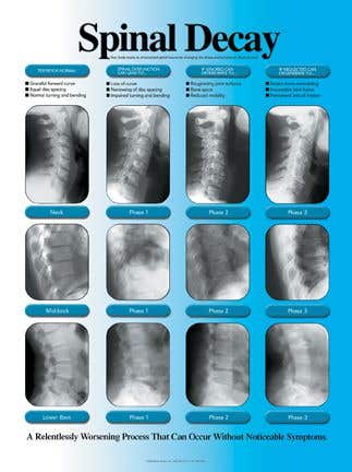 SpinalDecayChartSpinalDecayX-rayLaminatedPoster