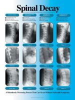 Spinal Decay ChartSpinal Decay X-ray Laminated Poster
