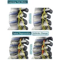 BodyPartChart Spinal Degeneration Series - Wall Decal