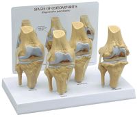 Four Stage Osteoarthritis Knee Model