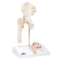 Femoral Fracture And Hip