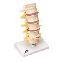 Stages Of Disc Prolapse & Vertebral Degeneration