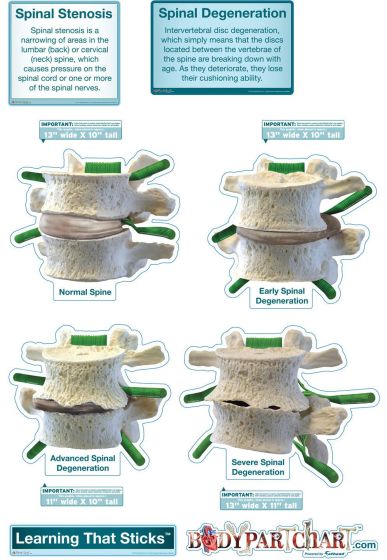 BodyPartChart Spinal Degeneration