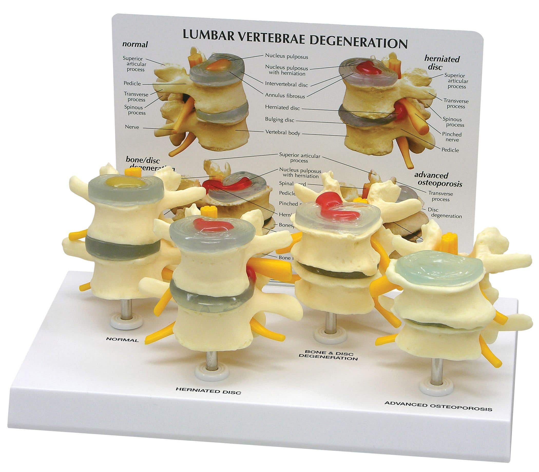 4StagesofLumbarDegeneration-VertebraeModels