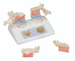 Anatomical model: osteoporosis model