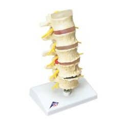 3b Scientific Anatomical Model - Vertebrae Degeneration, Stages Of Prolapsed Disc - Anatomical Model - Vertebrae Degeneration, Stages Of Prolapsed Disc